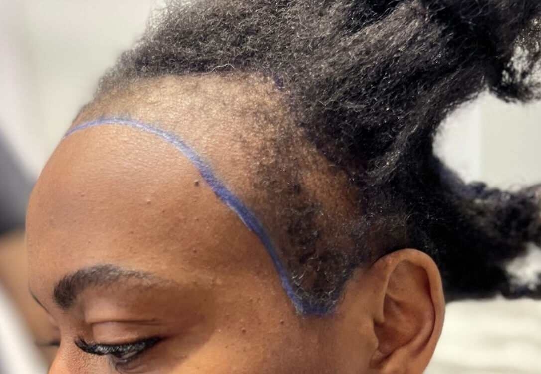 CAN I DO HAIR TRANSPLANT WITHOUT SHAVING