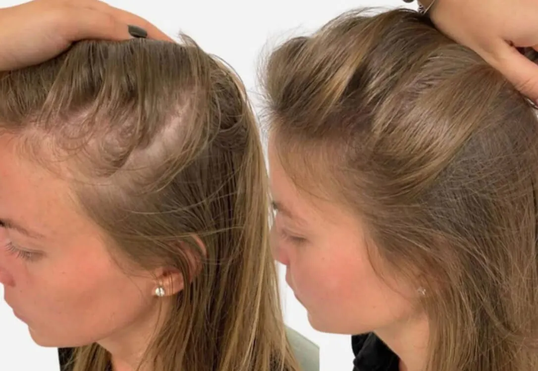CAN-A-HAIR-TRANSPLANT-BE-DONE-IN-WOMEN.jpg